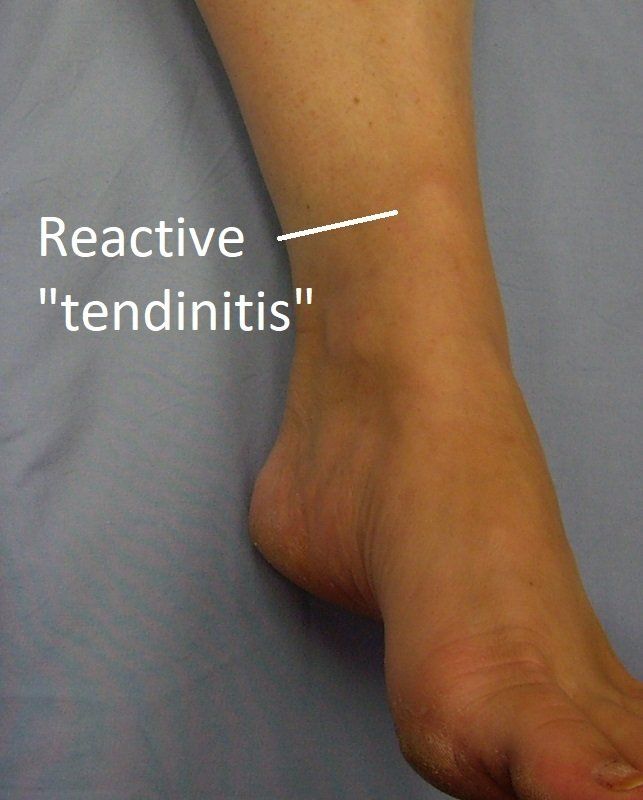 Ankle Tendon Dr Ben Beamond Orthopaedic Surgeon Adelaide